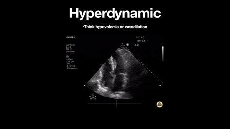 hyperdynamic left ventricular function results.